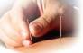 Acupuncture